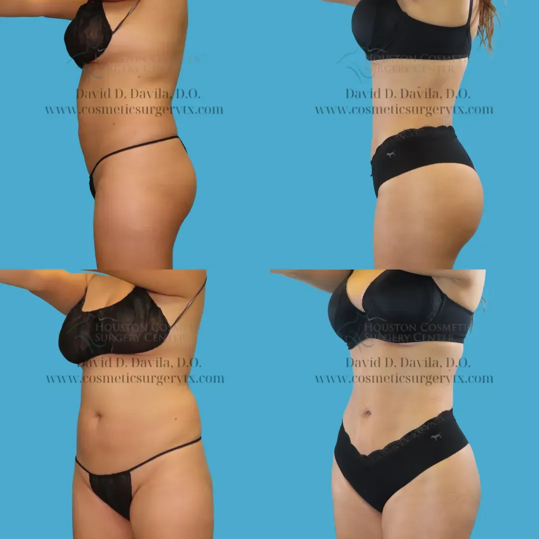brazilian butt lift Before and After